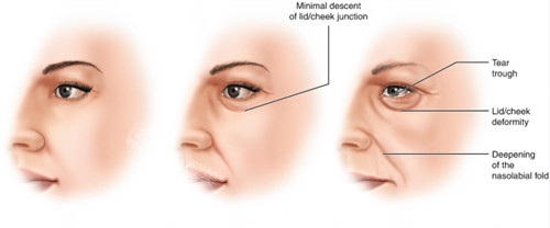 面部提升改善不同程度的面部老化 面部提升改善不同程度的面部老化