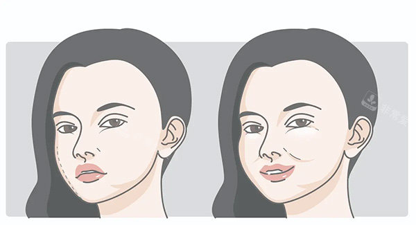 深圳恒研医疗美容怎么样正规吗?做钛提升/轮廓固定/馒化脸修复技术好,附简介地址! 