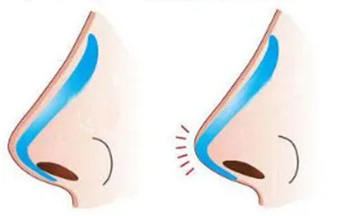 韩国喜悦整形怎么样好不好，做双眼皮/隆鼻/假体隆胸/吸脂手术特别好！
