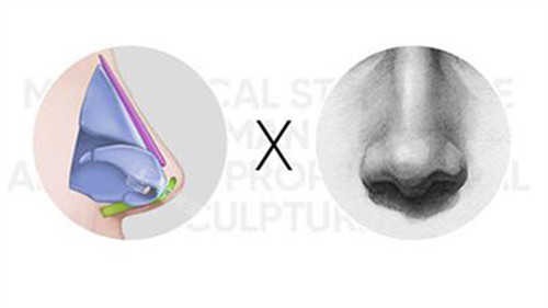 隆鼻改善展示照片 隆鼻改善展示照片