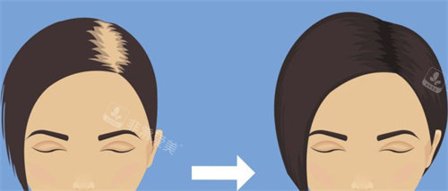 植发前后对比示图 植发前后对比示图