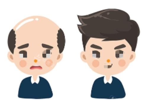 植发前后对比示意图 植发前后对比示意图