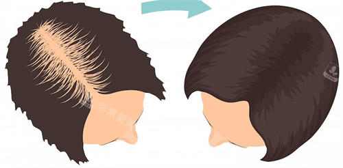发缝宽植发前后对比 发缝宽植发前后对比