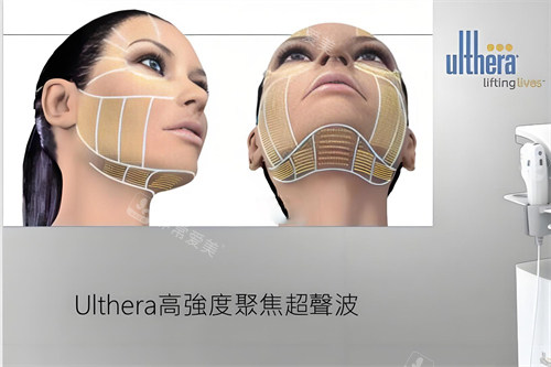 ulthera超声刀 ulthera超声刀