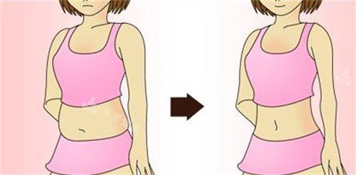 吸脂瘦身前后对比 吸脂瘦身前后对比