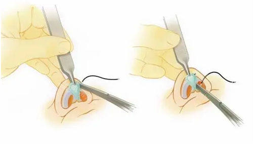 隆鼻手术鼻头过程展示图 隆鼻手术鼻头过程展示图