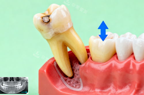 智齿拔除卡通展示图