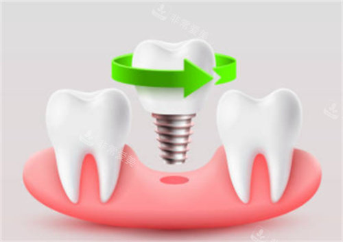 种植牙拧在牙床图