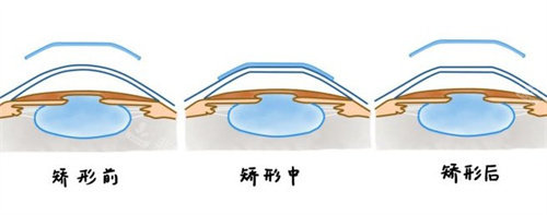 角膜塑形镜矫正原理