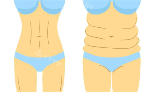 吸脂前后对比卡通图