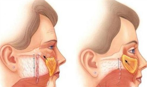 拉皮手术前后对比 拉皮手术前后对比