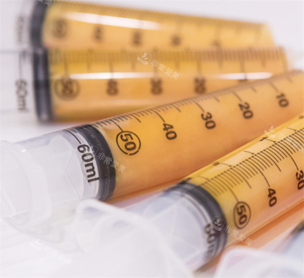 填充O型腿所需的自体脂肪图解