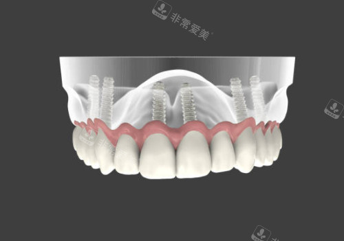 半口种植牙模型图