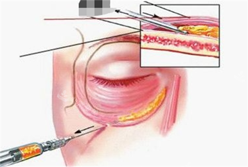 胶原蛋白注射眼部示意图 胶原蛋白注射眼部示意图