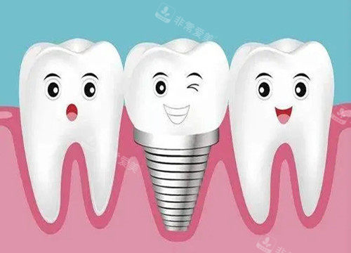种植牙和真牙卡通示意图