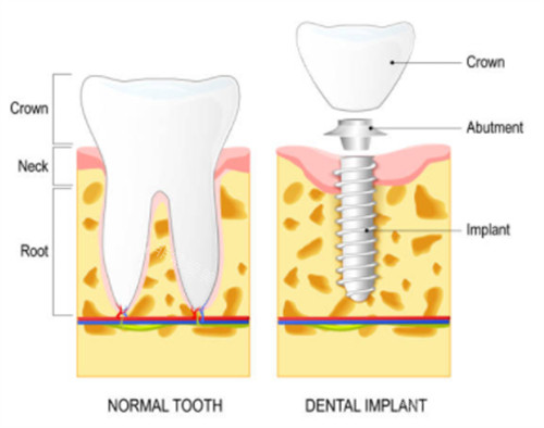 种植牙和正常牙齿对比图
