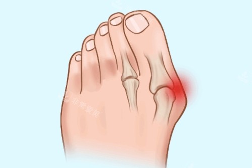 大脚骨疼痛卡通图 大脚骨疼痛卡通图
