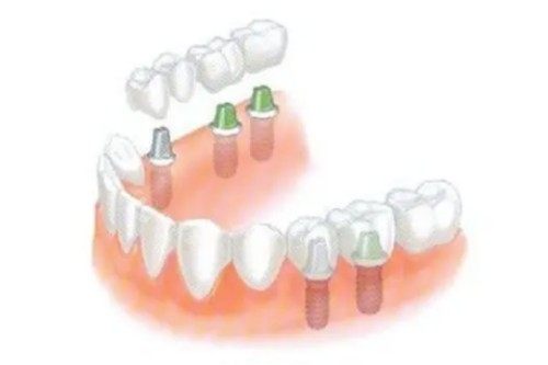 多颗种植牙卡通图片展示