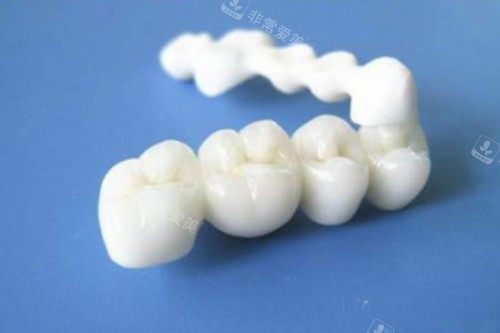 全瓷牙冠模型一览图