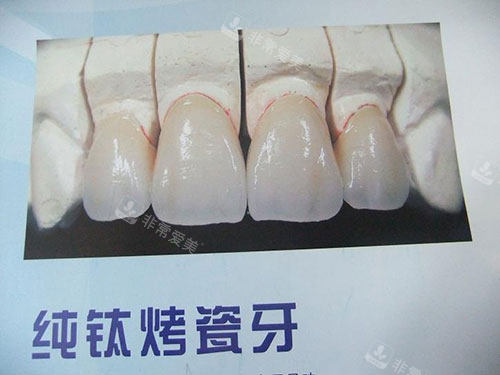 纯钛烤瓷牙模型展示图