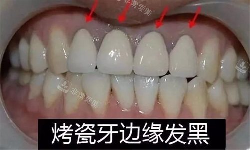 烤瓷牙边缘发黑
