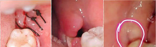 拔智齿缝合示意图