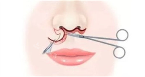 韩国人中缩短手术真实经历分享，过程顺利痛感轻微/术后结果自然显嫩/体验感很棒！