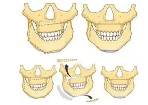 正頜手術(shù)卡通照片 正頜手術(shù)卡通照片