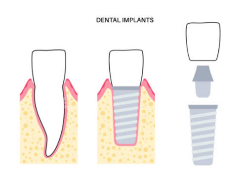 种植牙前后对比图片