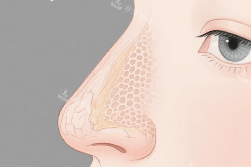 隆鼻动画示意图 隆鼻动画示意图