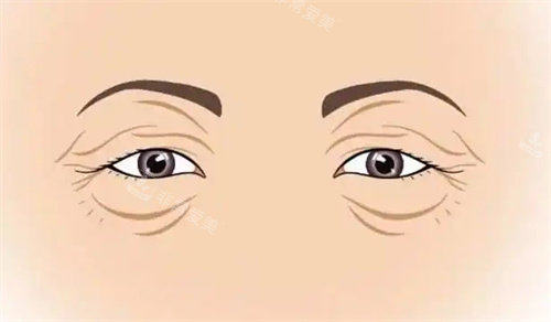 衰老的双眼皮 衰老的双眼皮