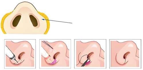 韩国鼻翼缩小针真实体验：从蒜头鼻到精致小翘鼻的逆袭全记录