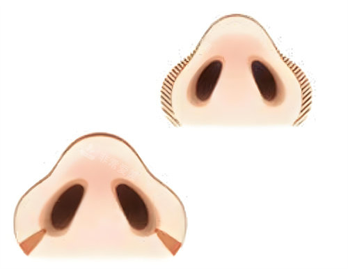 鼻翼縮小手術(shù)前后對比圖