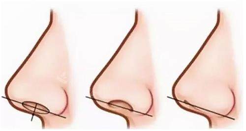 鼻翼緣后縮示意圖 鼻翼緣后縮示意圖