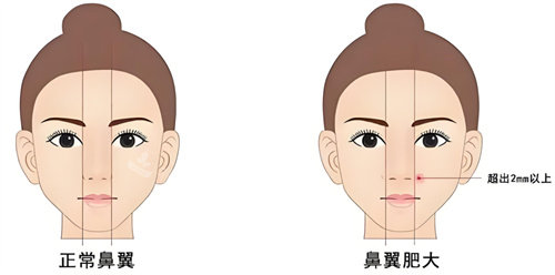 鼻翼縮小異常圖 鼻翼縮小異常圖