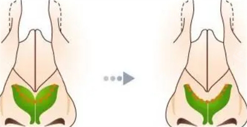 鼻翼軟骨 鼻翼軟骨