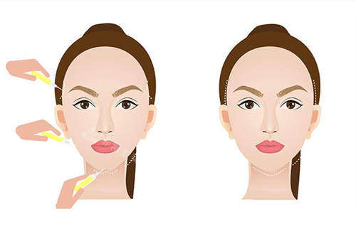 面部填充對(duì)比展示