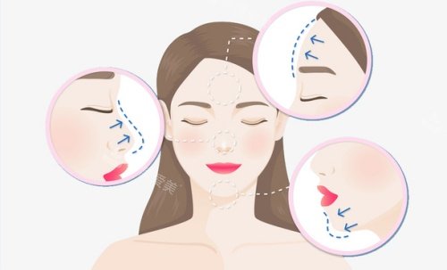 韩国做面部脂肪填充后没有寿星公很满意！填完像自然长肉，脸嘭得刚刚好！