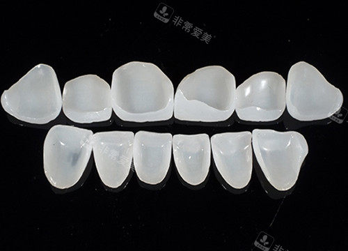 牙齒貼面玻璃陶瓷材料 牙齒貼面玻璃陶瓷材料
