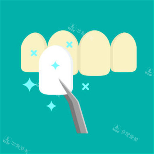 牙齒貼面圖 牙齒貼面圖