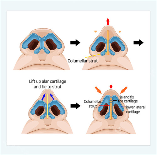 鼻翼縮小前后對(duì)比 鼻翼縮小前后對(duì)比