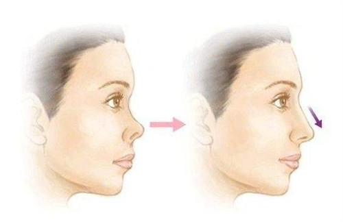 朝天鼻矯正對(duì)比圖 朝天鼻矯正對(duì)比圖