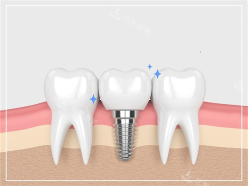种植牙与真实牙齿漫画示意图