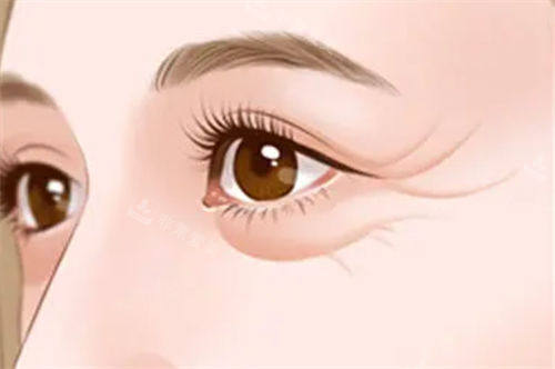 眼尾细纹展示图