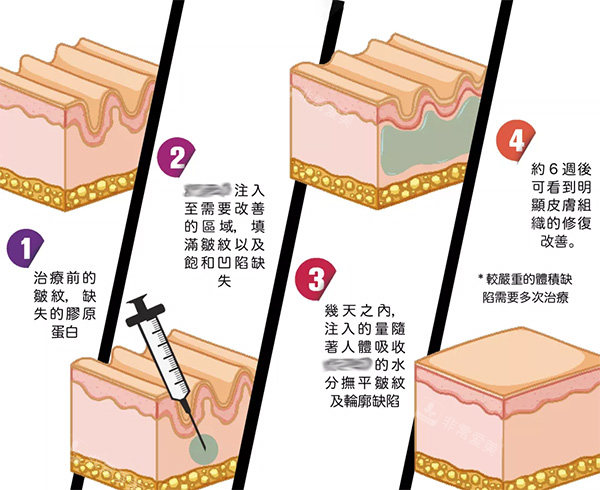 左旋乳酸PLLA清秀针注射照片