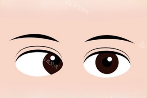 眼睛斜视卡通图