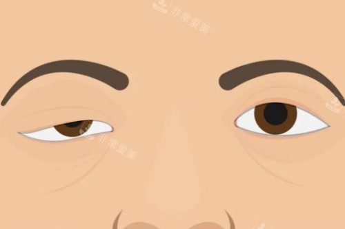 正常眼睛和整形失败眼睛对比图