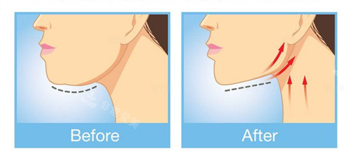 下巴提升紧致整形前后对比图