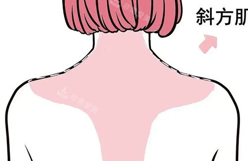 背部吸脂卡通示意圖 背部吸脂卡通示意圖