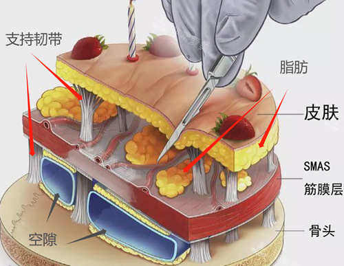SMAS筋膜层